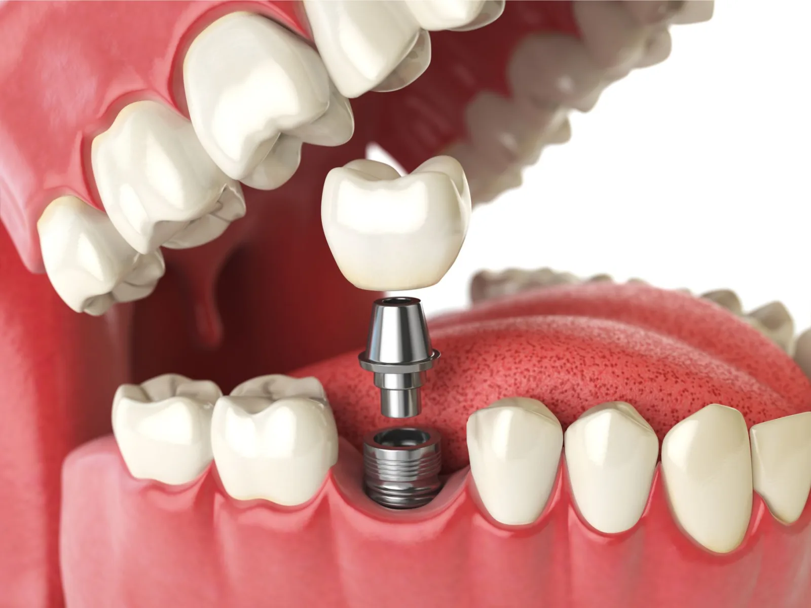 Is it time to consider dental implants? — dental care advice from Mathee Dental Studio, Somerset West